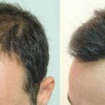 Quali sono le cause della perdita dei capelli negli uomini?