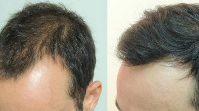 Quali sono le cause della perdita dei capelli negli uomini?