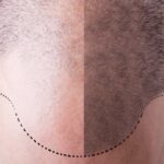 Nascondere la calvizie con la tricopigmentazione: pro e contro