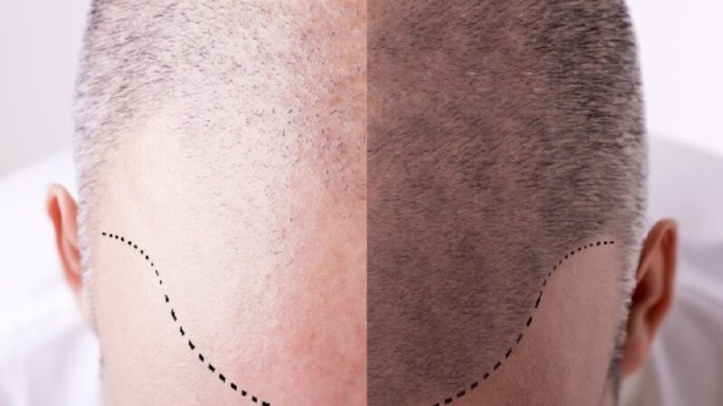 Nascondere la calvizie con la tricopigmentazione: pro e contro